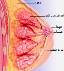 سرطان الثدي