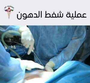 عملية شفط الدهون