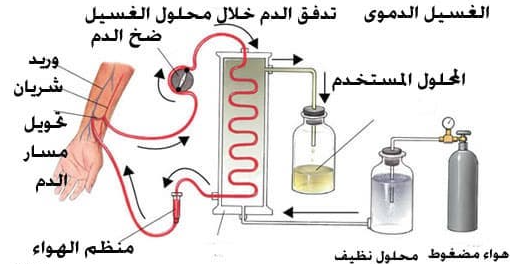 الغسيل الكلوي الدموي